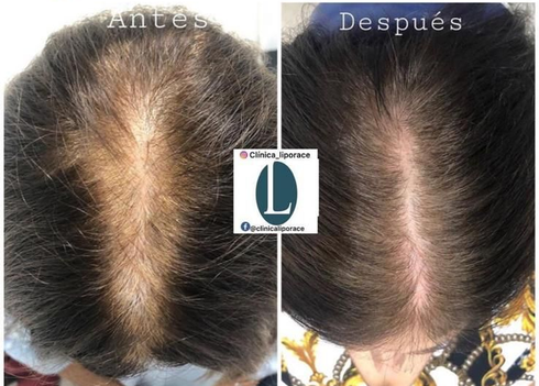 Unas manos enguantadas aplican un tratamiento en el cuero cabelludo de un hombre con una pequeña herramienta en un entorno clínico