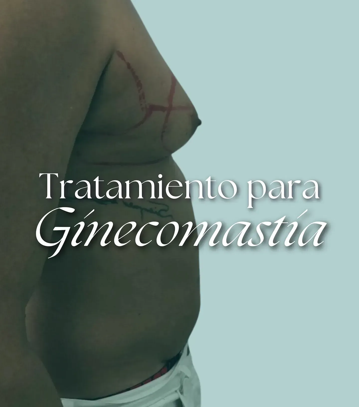 Perfil lateral de un torso con marcas en el pecho y el texto «Tratamiento para Ginecomastia»