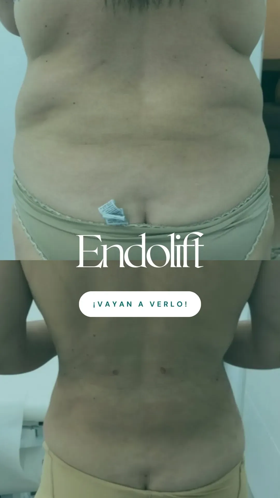 Vista frontal del abdomen antes y después del tratamiento con Endolift, donde se aprecia una reducción del volumen abdominal.
