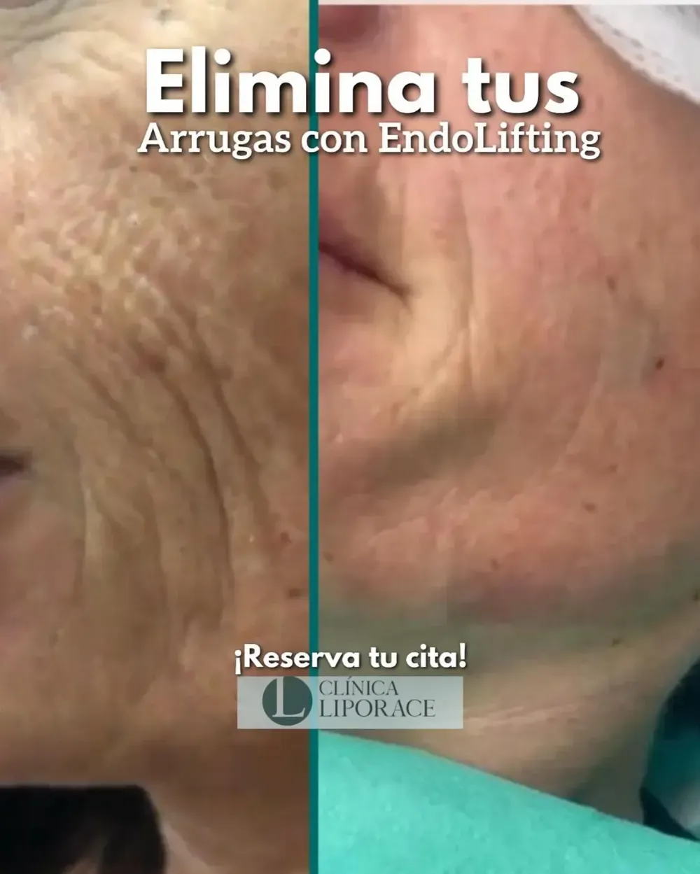 Primer plano del antes y el después de una oreja y una mejilla que muestra una reducción de las arrugas tras el tratamiento de Endolifting.