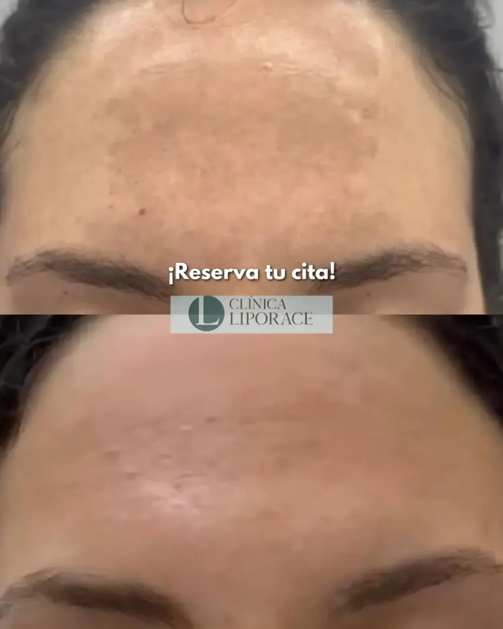 Frente antes y después, mostrando una piel más lisa y menos imperfecciones; texto superpuesto: «¡Reserva tu cita!»