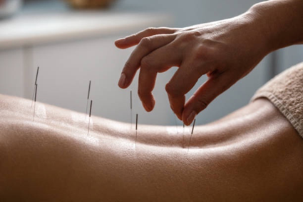 tecniche di agopuntura