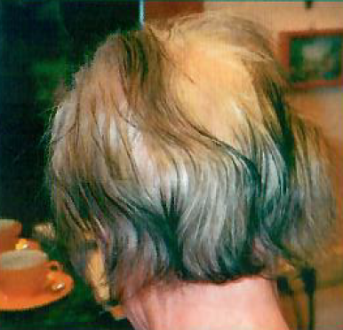 Lichtes Haar auf dem Kopf