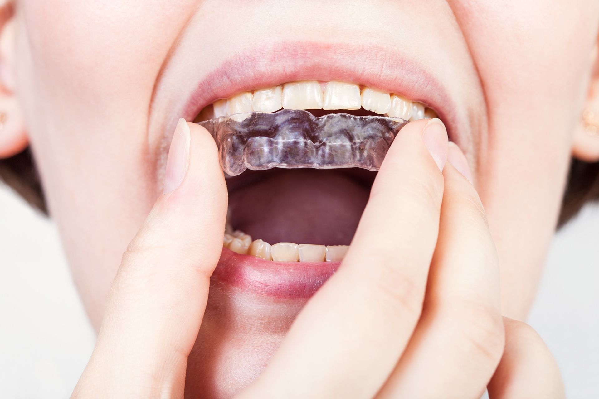 Un primer plano de una persona sosteniendo un retenedor dental en la boca.