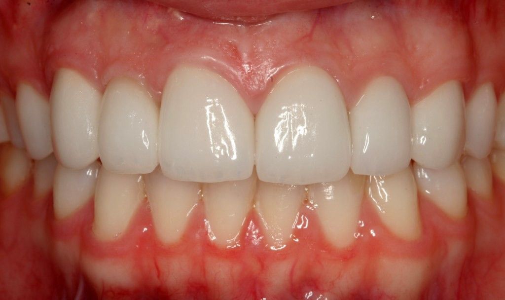 Un primer plano de los dientes de una persona con dientes blancos.