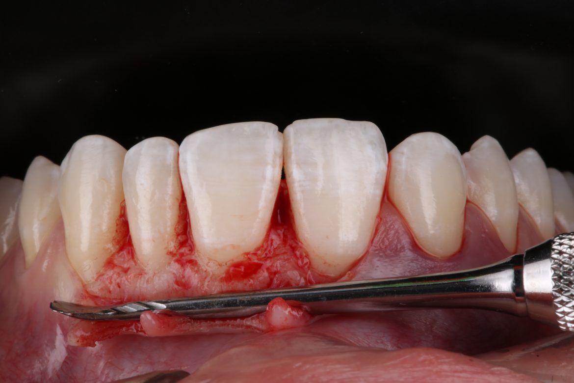 Un primer plano de los dientes de una persona con un cepillo de dientes en la boca.