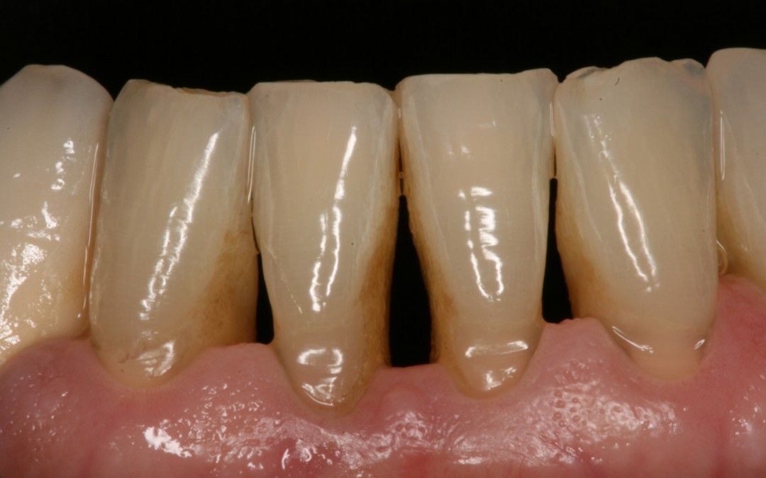 Un primer plano de los dientes de una persona con un fondo negro.