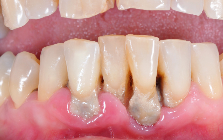 Un primer plano de los dientes de una persona con mucha placa en ellos.