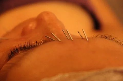 Una mujer está recibiendo tratamiento de acupuntura en su cara.
