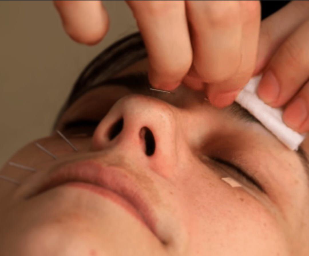 Una mujer está recibiendo tratamiento de acupuntura en su cara.