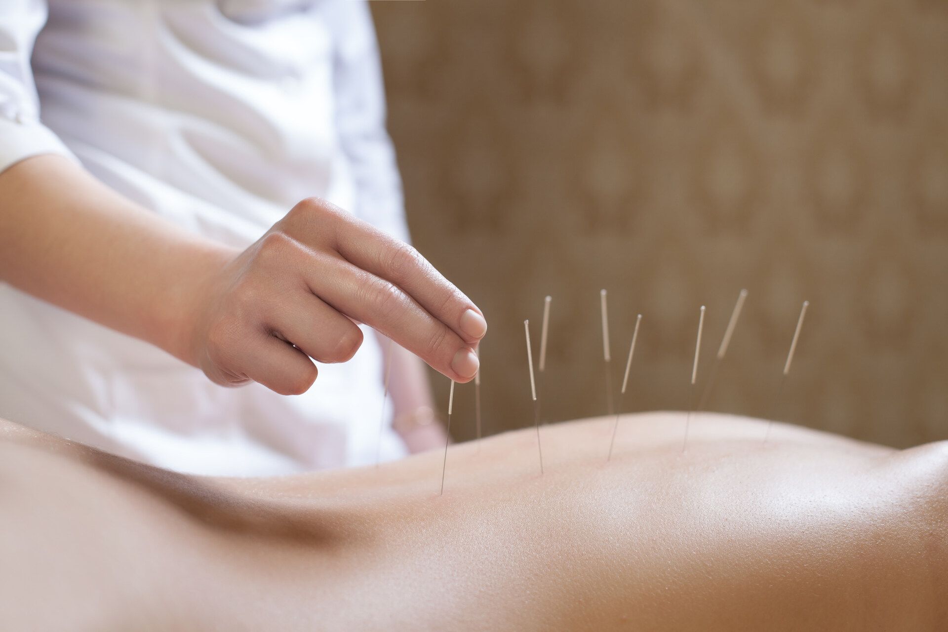 Mitarbeiterin der Praxis Traditionelle Chinesische Medizin Barbara Schatt führt bei Kunden Akupunktur durch