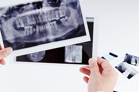 Una persona sostiene una radiografía de sus dientes.