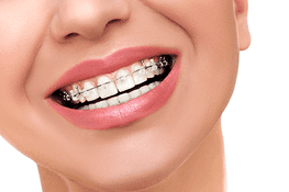 Un primer plano de la sonrisa de una mujer con aparatos dentales.