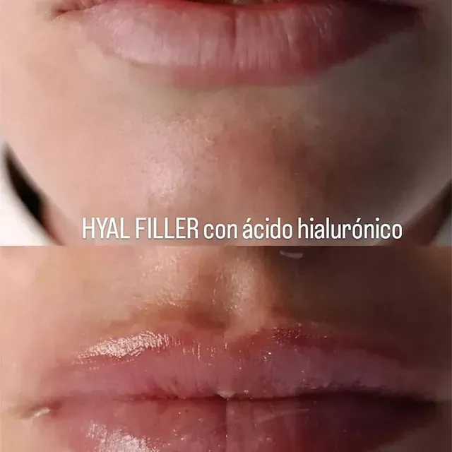 Una fotografía de antes y después de los labios de una mujer con una inyección de ácido hialurónico.