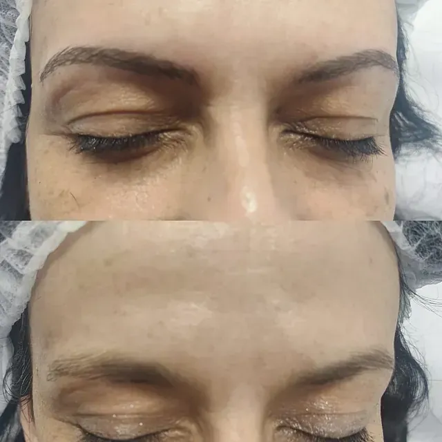 Una fotografía de antes y después de la frente de una mujer con los ojos cerrados.
