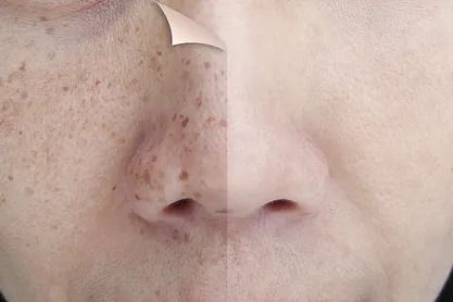 Una foto de antes y después de la cara de una mujer con pecas.