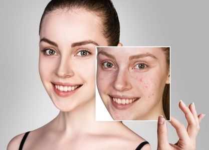 Una mujer sostiene una fotografía de su rostro antes y después del tratamiento del acné.
