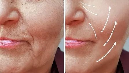 Una fotografía de antes y después de la cara de una mujer con flechas que apuntan a las arrugas.