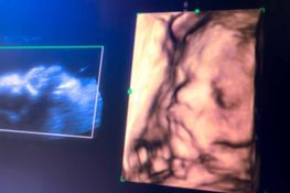 Echographie 4D - Dr Neus Ymbernon