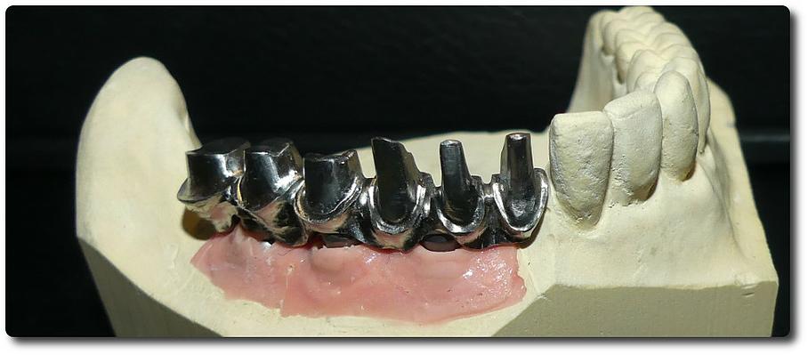 Implant dentaire transvissé