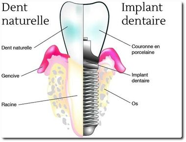 Plan implant dentaire