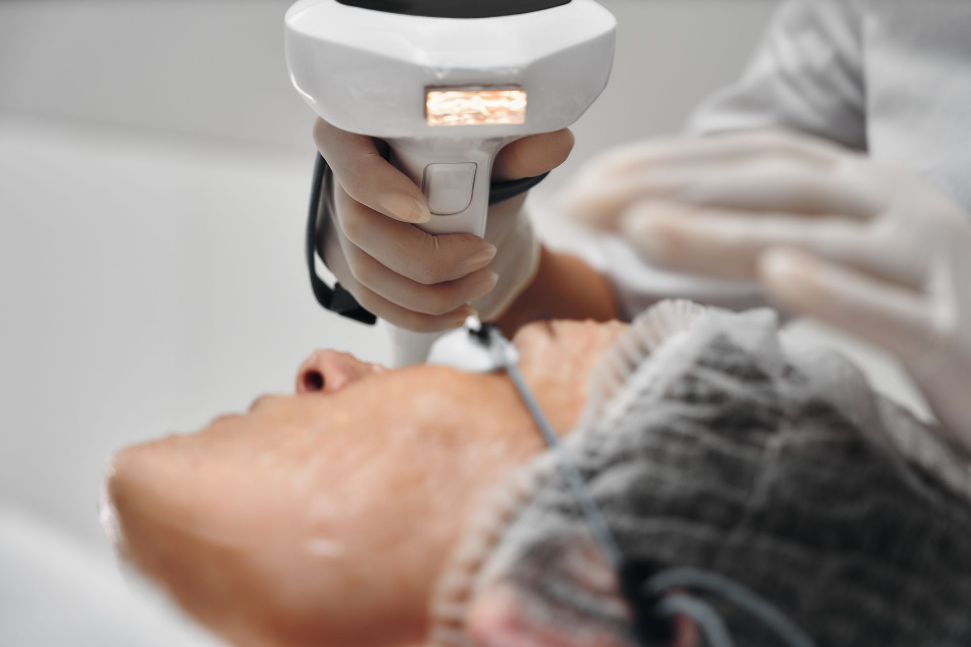 Person, die eine Laser-Hautbehandlung im Gesicht erhält, gehalten von einer behandschuhten Hand.