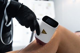 Eine Frau lässt sich am Bein eine Laser-Haarentfernung durchführen.