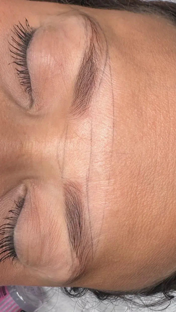 Primer plano de un ojo y una ceja cerrados, con una pequeña protuberancia roja en el párpado superior.