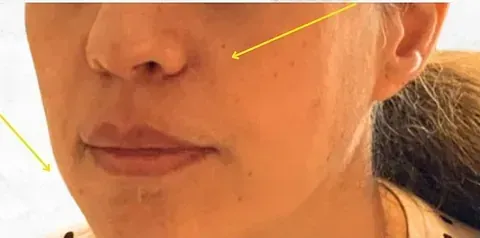 Un primer plano del rostro de una mujer con una flecha amarilla apuntando a su nariz.