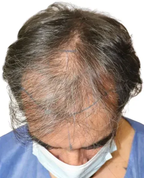 Un hombre con una máscara en la cara mira su cabello.