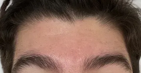 Un primer plano de la frente y las cejas de un hombre.