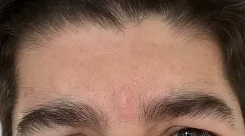 Un primer plano de la frente y las cejas de un hombre.