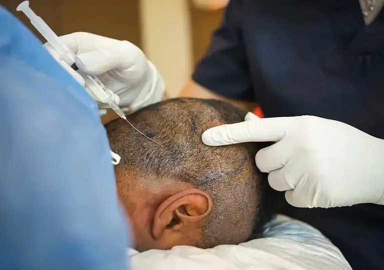 Un hombre se hace un trasplante de cabello en la cabeza.
