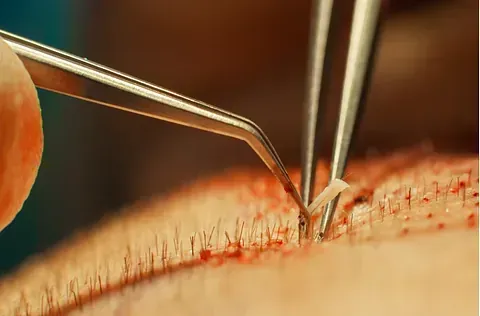 Un primer plano de una persona que recibe un trasplante de cabello con pinzas.