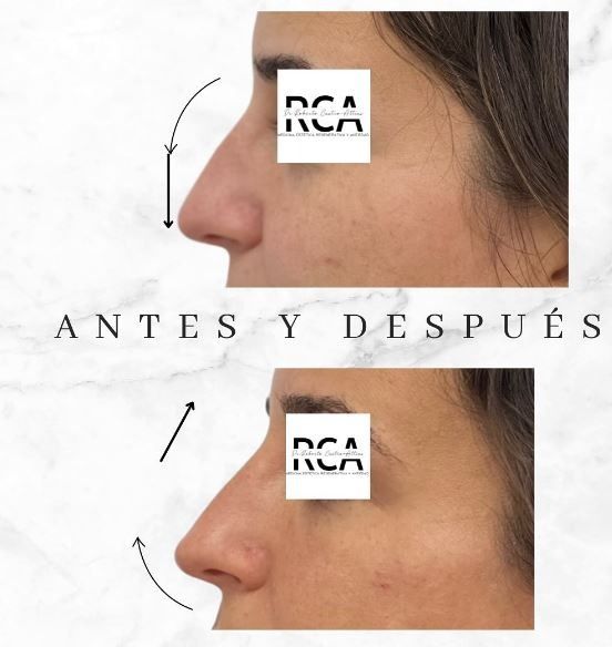 Una foto de antes y después de la nariz de una mujer.