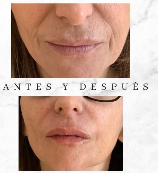 Una foto de antes y después del rostro de una mujer.