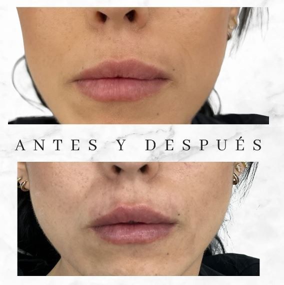 Una foto de antes y después del rostro de una mujer con las palabras antes y despues