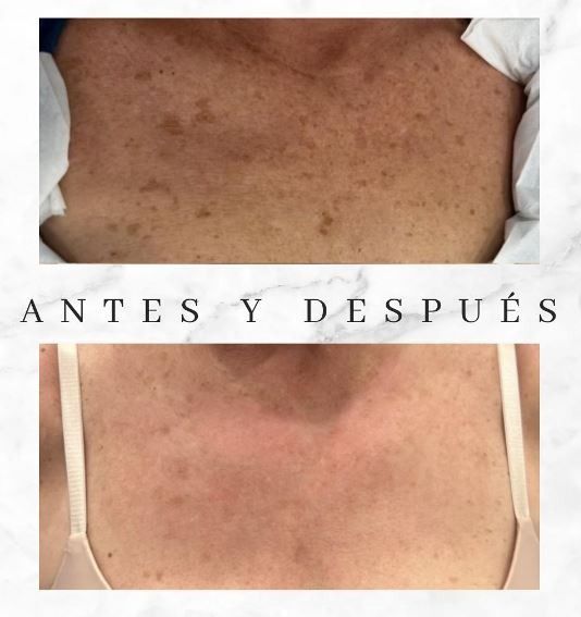 Una foto de antes y después del cuello y el pecho de una mujer.