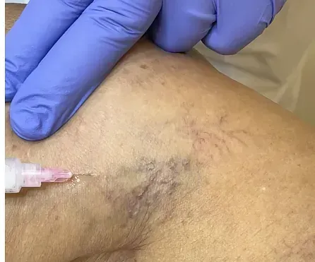 Una persona recibe una inyección en la pierna con una jeringa.