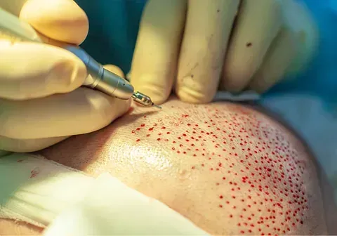Una persona está usando un bolígrafo para dibujar una línea en la cabeza de una persona.