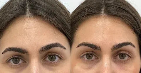 Una foto de antes y después de la frente de una mujer.