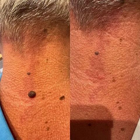 Una foto de antes y después del cuello de un hombre con un lunar.