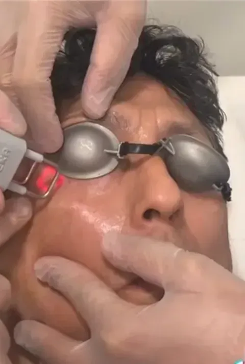 Un hombre que lleva gafas protectoras está recibiendo un tratamiento con láser en la cara.