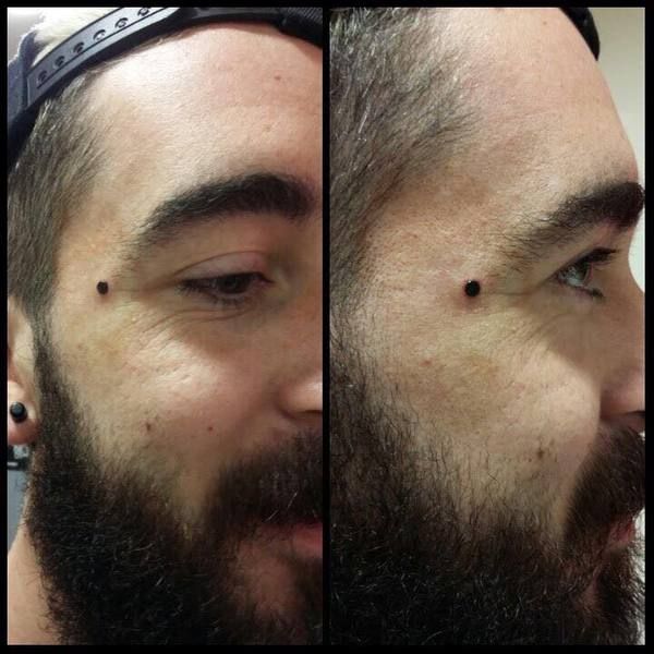 Piercing microdermal - piercing noir derrière l'œil