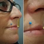 Piercing bouche Labret et Madonna - perle bleue en haut à droite