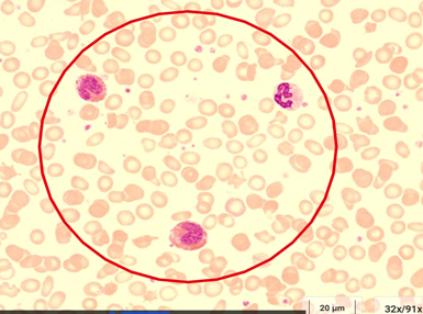 © eLCH Curriculum Hämatologie DGHO