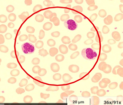 © eLCH Curriculum Hämatologie DGHO