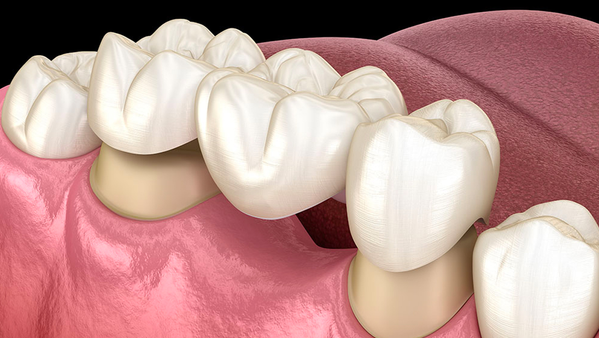 protesi fisse - Fiorenzo Fraschina