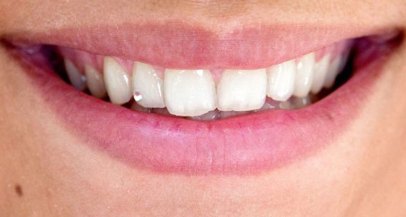 Faccette dentali resina e porcellana a Lugano - Clinica Pentadent Swiss