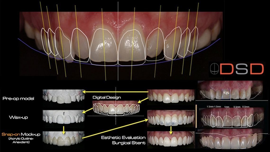 Faccette dentali esempio 3 - Fiorenzo Fraschina